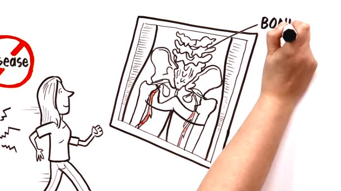 Everything you need to know about Low Back Pain right here!