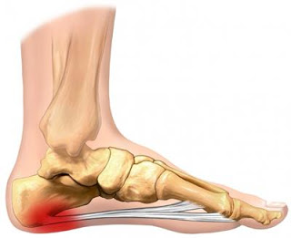What causes heel pain and plantar fasciitis?