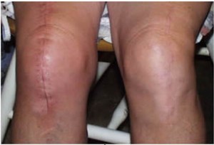 Do you have questions about your total hip or total knee replacement?